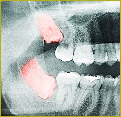 xray